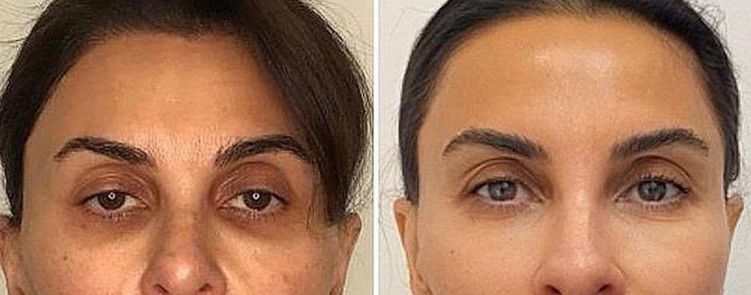 Epione Beverly Hills Redefines Beauty with Long Lasting Dark Circle Treatment